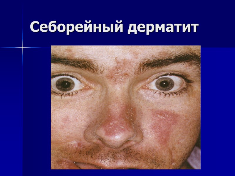 Себорейный дерматит